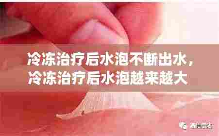 冷冻治疗后水泡不断出水，冷冻治疗后水泡越来越大 