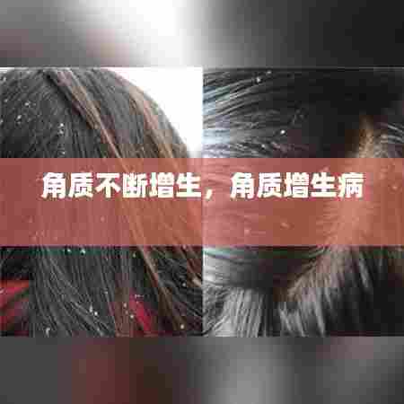 角质不断增生,角质增生病