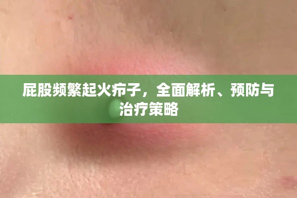 屁股频繁起火疖子,全面解析、预防与治疗策略